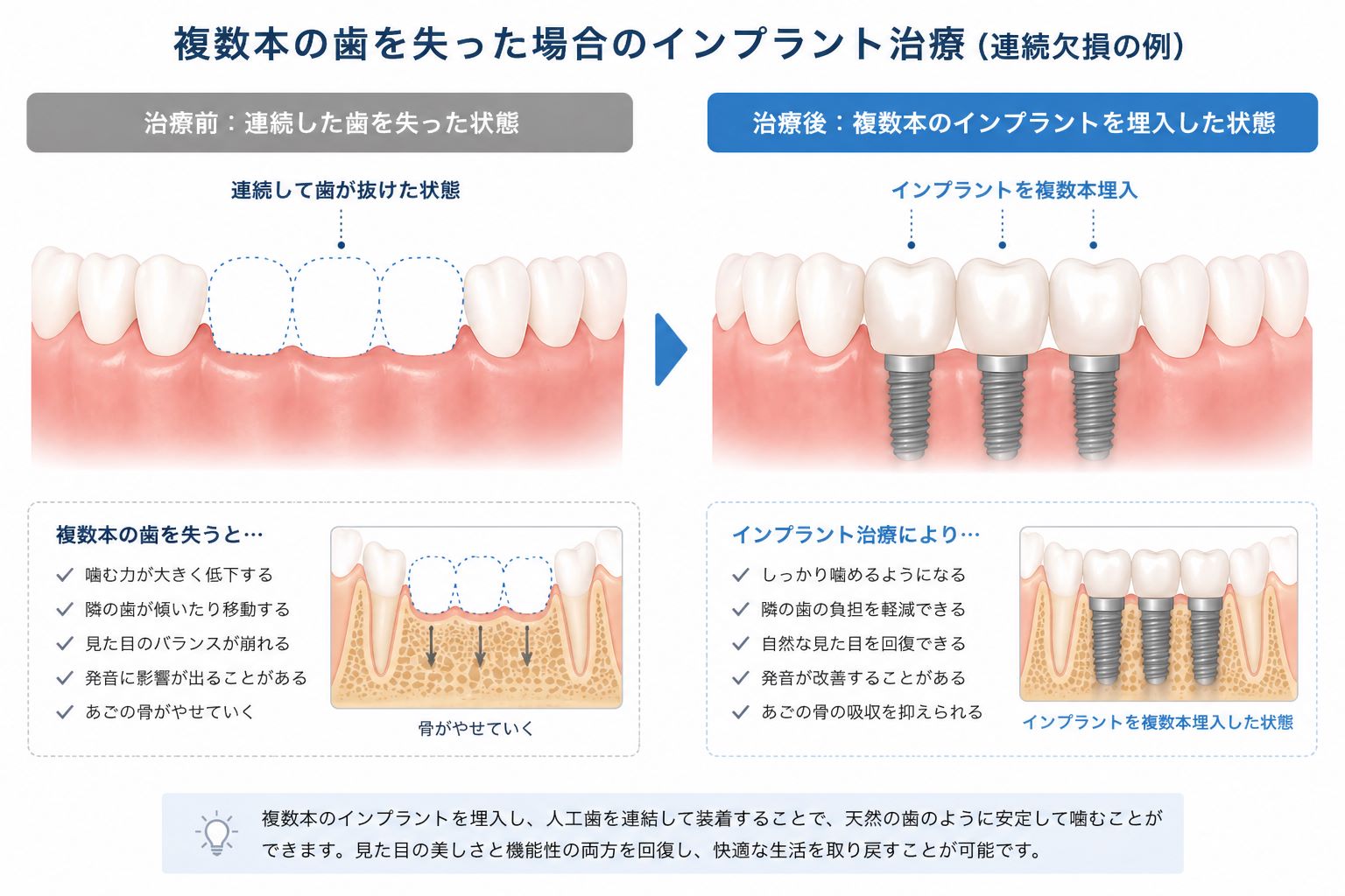 インプラント治療｜刈谷市の歯医者｜痛みの少ない歯科治療「やまむら
