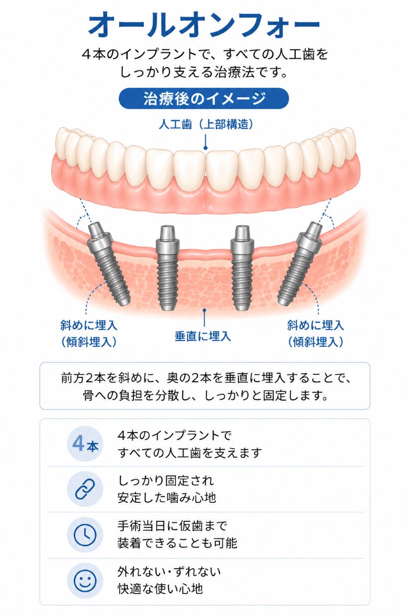 インプラント治療｜刈谷市の歯医者｜痛みの少ない歯科治療「やまむら
